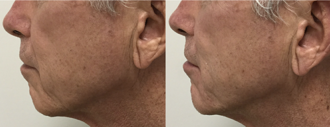 Restylane_BandA_4
